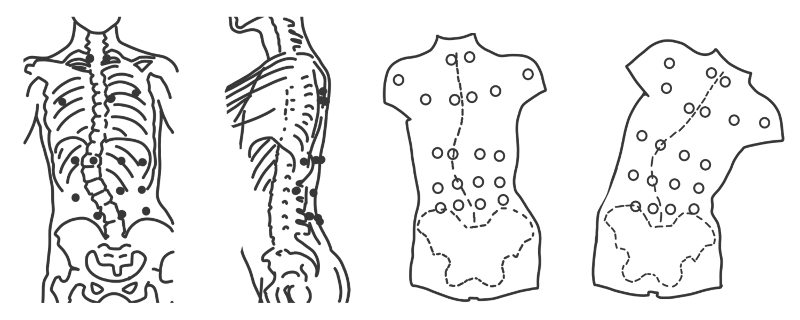 Scoliosis Studies